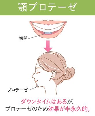 【必見】顎のヒアルロン酸はダウンタイムがある？仕上がりのデザインから上手な先生まで徹底調査！