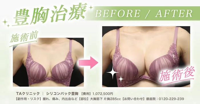 【必見】豊胸したら後悔するって本当？デメリットも合わせておすすめの豊胸術を徹底調査