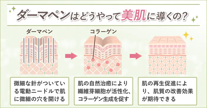 ダーマペンの仕組み