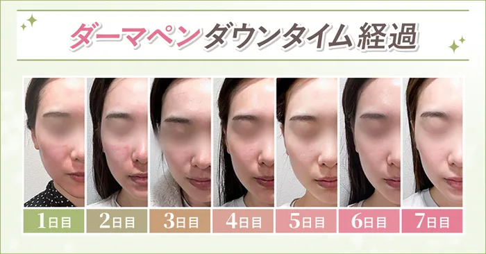 針の深さと効果の違い