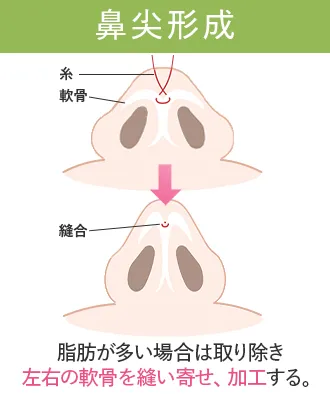 鼻整形おすすめクリニック