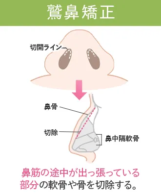 鼻整形おすすめクリニック