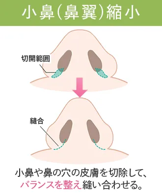 鼻整形おすすめクリニック