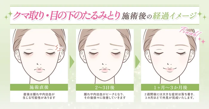 目の下のたるみ取り施術件数の推移