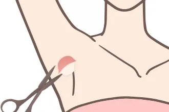 ミラドライ