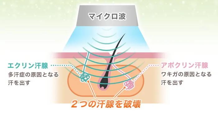 ミラドライがワキガや多汗症に効果を発揮する仕組み