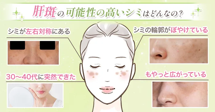 ピコレーザーなどのシミ取りレーザーをすべきシミの種類を紹介