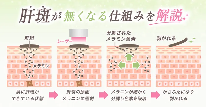 ピコレーザーでシミが消える仕組み