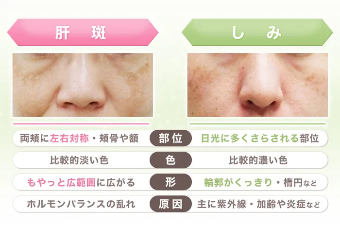 肝斑