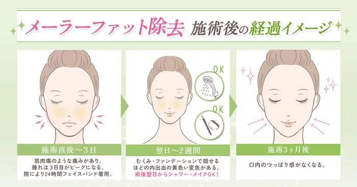 メーラーファットダウンタイム