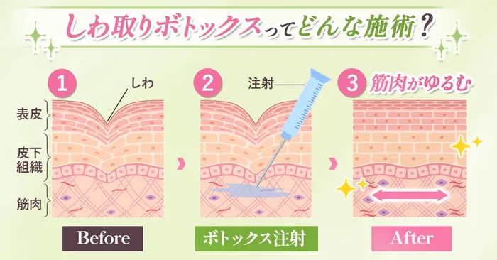シミ取りボトックス効果のロジック