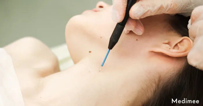 【自分で切除したり市販薬を使うより安全で簡単】ホクロ・イボ除去おすすめ施術方法3選