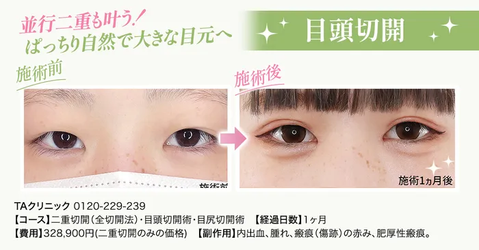 二重目頭切開症例
