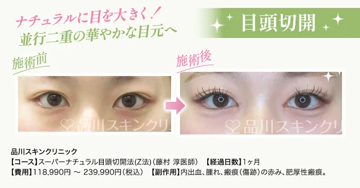 二重目頭切開症例