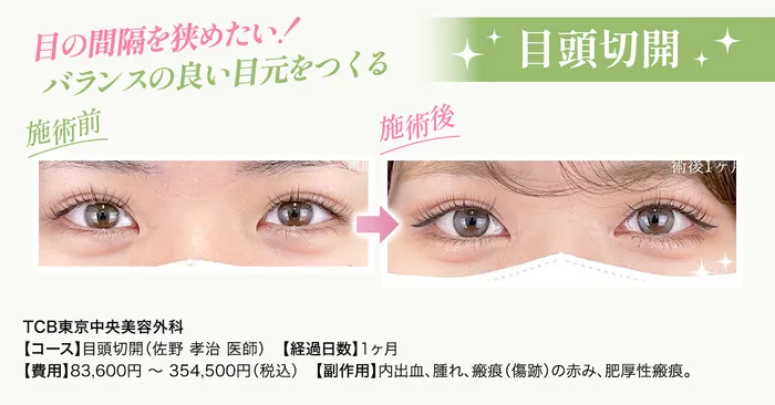 二重目頭切開症例