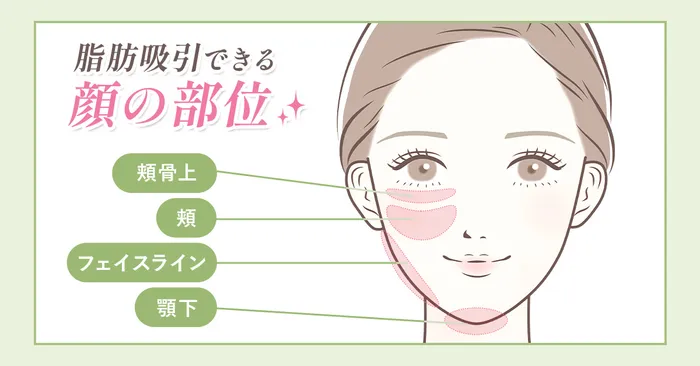 小顔脂肪吸引の女性