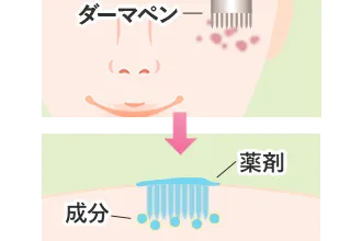 ケミカルピーリング
