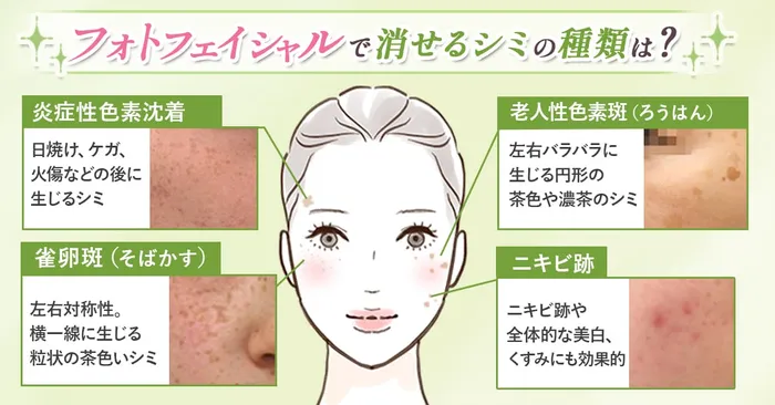 フォトフェイシャルで消せるシミの種類