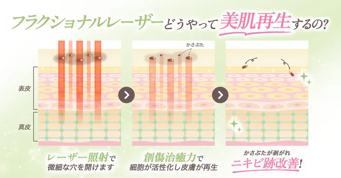 フラクショナルレーザー効果のロジック