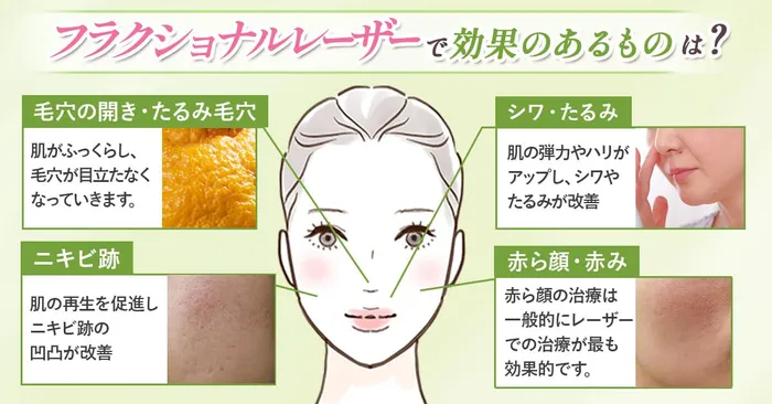 フラクショナルレーザー悩みの自分ごと化