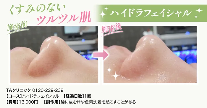 ハイドラフェイシャルを受けるならエステor医療機関？それぞれの違いを徹底解説