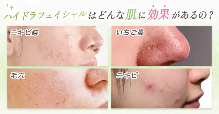 ハイドラフェイシャルを受けるならエステor医療機関？それぞれの違いを徹底解説