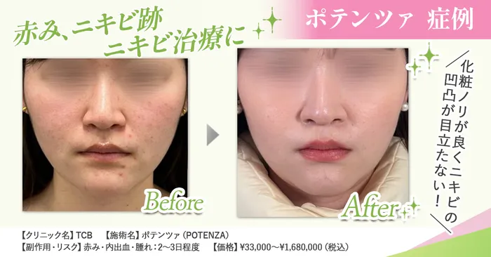 【毛穴やニキビ跡を一度で改善】究極の美肌を叶えるポテンツァの効果とは?ダーマペンとの違いも合わせて徹底解説
