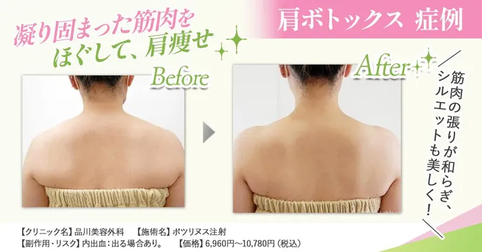 肩ボトックスについて