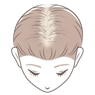 【女性専門】薄毛AGA治療おすすめクリニック5選！女性の薄毛を確実に治す方法とは