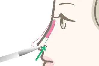 “【必見】鼻のヒアルロン酸はダウンタイムがある？仕上がりのデザインから上手な先生まで徹底調査！”