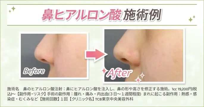 “【必見】鼻のヒアルロン酸はダウンタイムがある？仕上がりのデザインから上手な先生まで徹底調査！”
