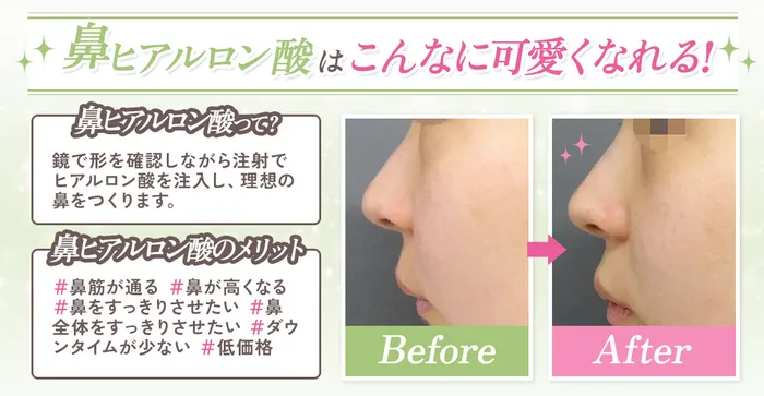 【必見】鼻のヒアルロン酸はダウンタイムがある？仕上がりのデザインから上手な先生まで徹底調査！
