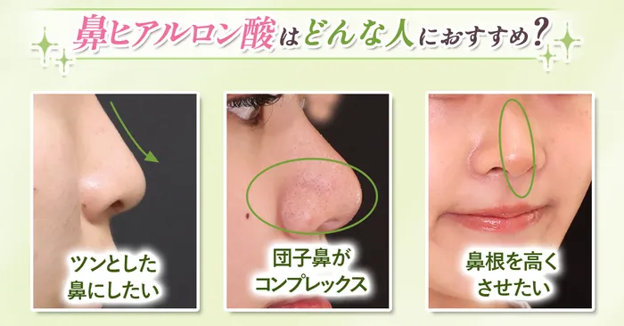 【必見】鼻のヒアルロン酸はダウンタイムがある？仕上がりのデザインから上手な先生まで徹底調査！