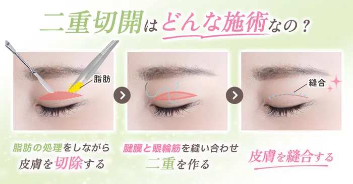二重切開法症例