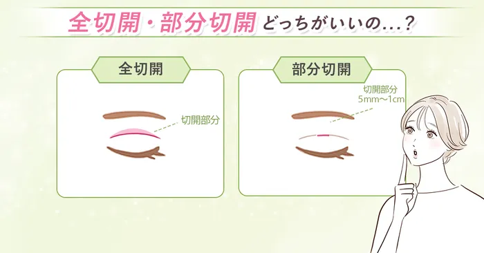 二重切開　おすすめ