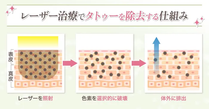 レーザーのロジック