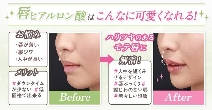 【必見】唇のヒアルロン酸はダウンタイムがある？仕上がりのデザインから上手な先生まで徹底調査！