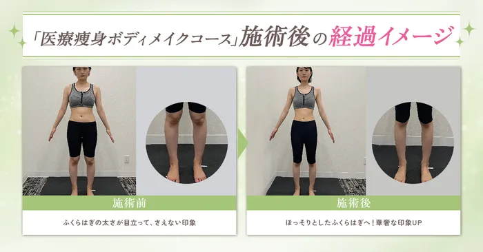 【部分痩せ】脂肪冷却でふくらはぎ痩せはできるの？脂肪冷却のふくらはぎ痩せへの効果を徹底解説