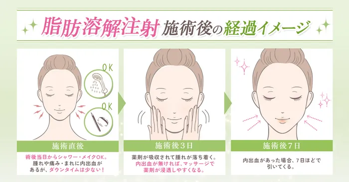 小顔脂肪溶解注射