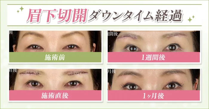 眉下切開ダウンタイム画像