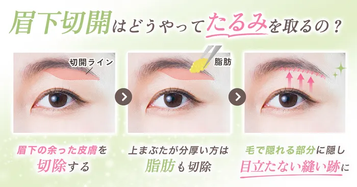 眉下切開効果のロジック