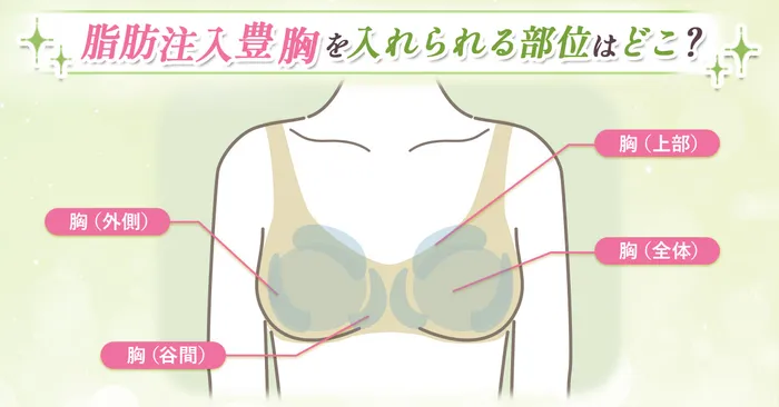 脂肪注入豊胸注入箇所画像