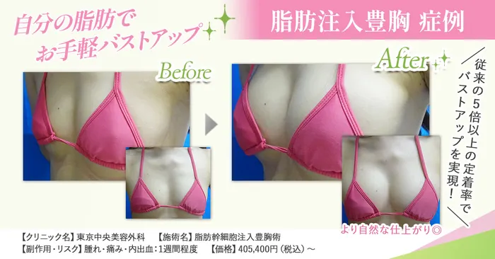 脂肪注入豊胸BA画像