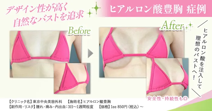 ヒアルロン酸豊胸BA画像
