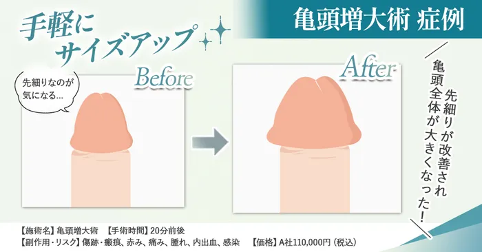 亀頭増大術症例