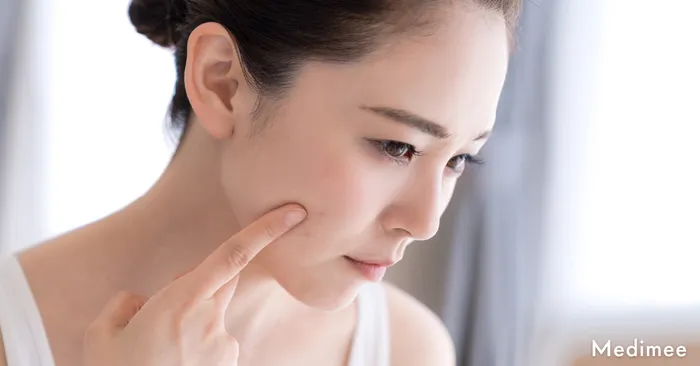 ダウンタイム期間中に起きる「拘縮」は通常の反応で問題なし!落ち着くまでの期間やケア方法とは