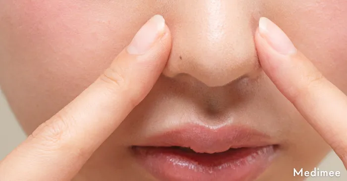ハイドラフェイシャルの効果はいちご鼻にいつから現れる?施術後の経過を徹底解説