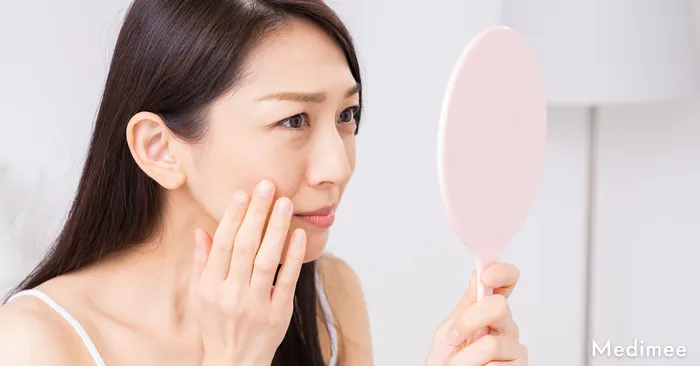 ケミカルピーリングがニキビ跡の色素沈着に「効果ない」と感じるのはどんなケース?当てはまる人は注意を