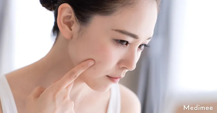 ポテンツァでニキビ跡を改善させるために必要な回数は?しっかり治したい人は複数回を推奨