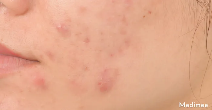 サブシジョンのダウンタイムとは?ダウンタイムは皮膚の回復に必要な期間